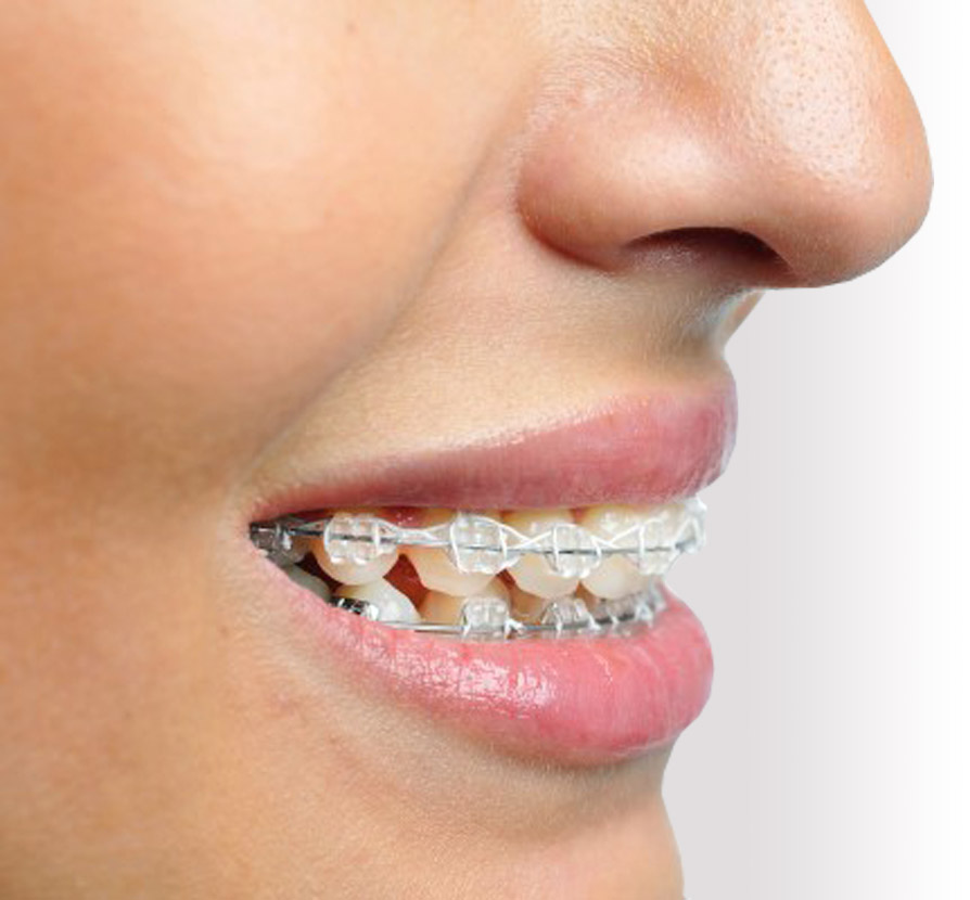 What are the benefits of clear braces? What are the benefits of clear braces?