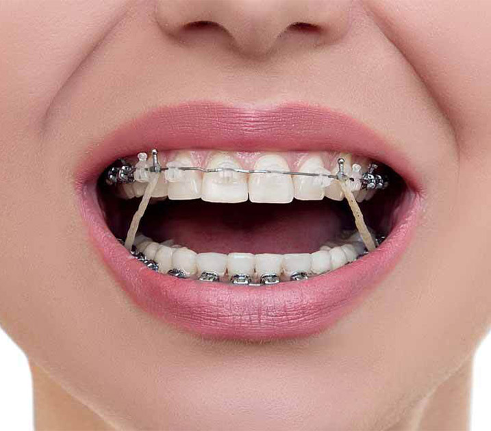 Elastics Elastics