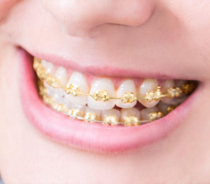 How do gold braces work? How do gold braces work?