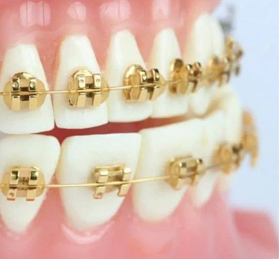 Why should I choose gold braces? Why should I choose gold braces?