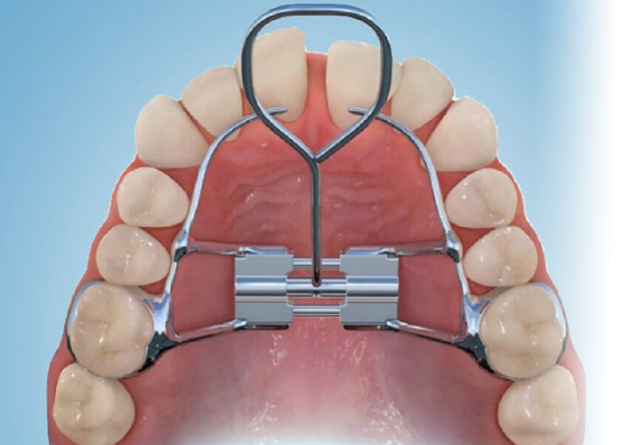 Palatal expander Palatal expander