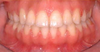 Invisalign Invisalign