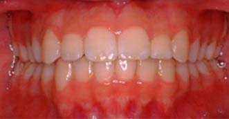 Invisalign Invisalign