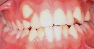Invisalign Invisalign