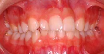 Invisalign Invisalign