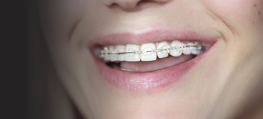 clear-braces-hero.jpg clear-braces-hero.jpg