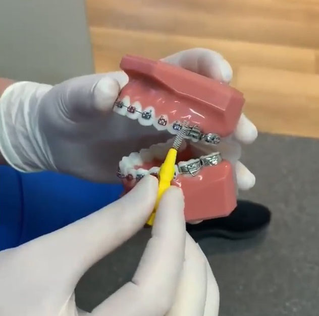 How do metal braces work? How do metal braces work?