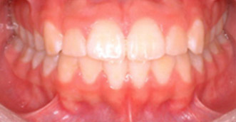 Before and after 3 Before and after 3