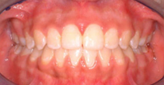 Before and after 4 Before and after 4