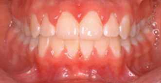 Before and after 5 Before and after 5